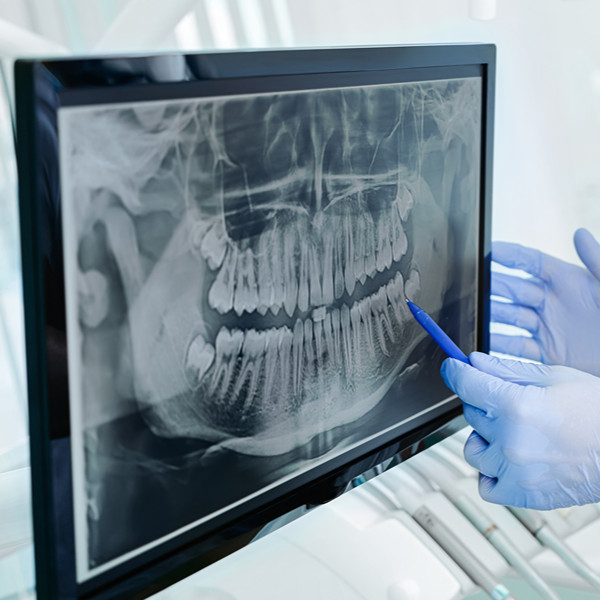 roya-oral-surgery-dentist-gloves-showing-teeth-xray-screen-closeup